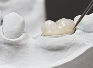 Model of tooth with dental crown restoration