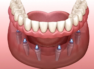 Illustration of denture for lower arch, supported by six implants