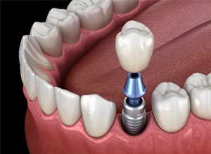 dental implant beside other teeth