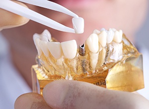 Abington Restorative Dentistry Model of implant supported dental crown