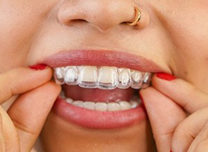 Close-up of woman’s mouth as she places Invisalign aligner on her teeth