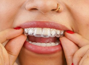 Close-up of woman’s mouth as she places Invisalign tray on her teeth