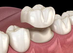 Illustration of all-ceramic dental crown in Abington on lower tooth