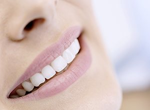 Closeup of smile with porcelain veneers