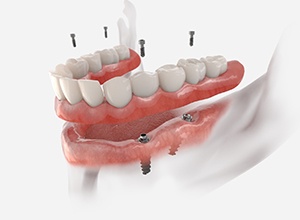 Illustration of implant dentures being placed in lower dental arch