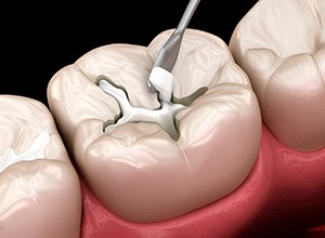 Illustration of tooth-colored filling being paced in cavity in Abington