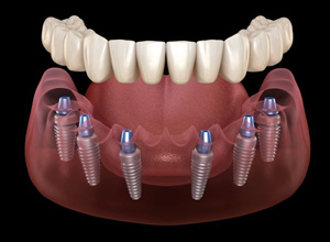 Illustration of implant denture against dark background