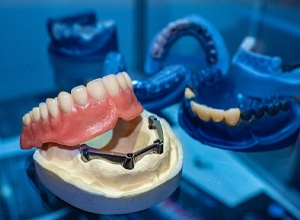 Implant denture resting on model of jawbone in dental lab
