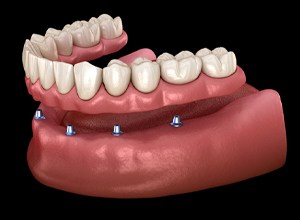 Illustration of implant denture for lower arch against black background