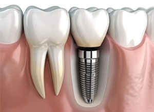 assets/images/implant-process-1.jpg