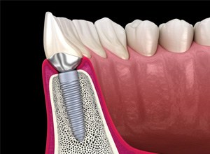 Side-view of dental implant in jawbone