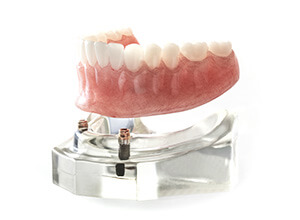 3D Model of Mini Dental Implant