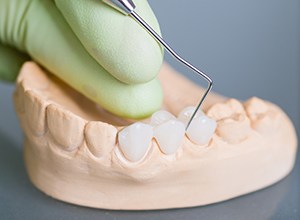 Model of teeth with fixed bridge restoration