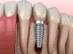 Man smiling after dental implant failure and salvage in Abington