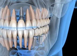 Illustration of three dental implants in patient’s mouth