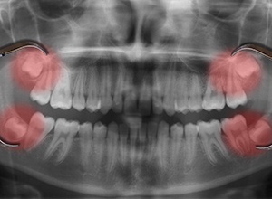 Panoramic dental x-ray