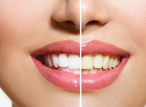 Woman’s smile before and after teeth whitening service