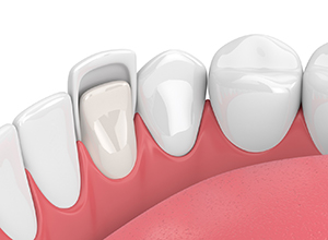 Illustration of dental veneer on front tooth