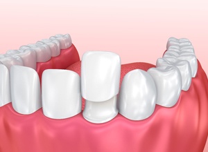 porcelain veneer illustration