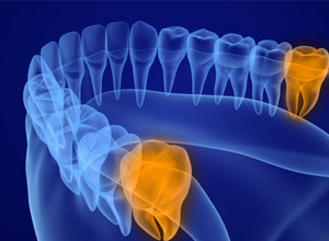 wisdom teeth illustration