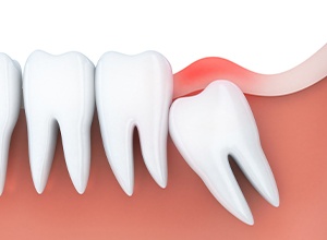 Graphic of of wisdom tooth