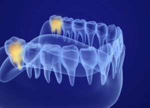 wisdom teeth illustration
