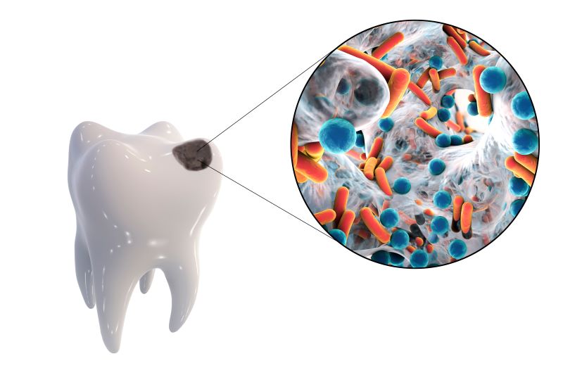 Dental Filling Fell Out? Here Is What You Should Do