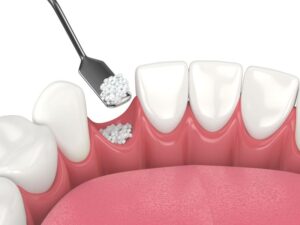 Illustration of bone graft being placed in tooth socket